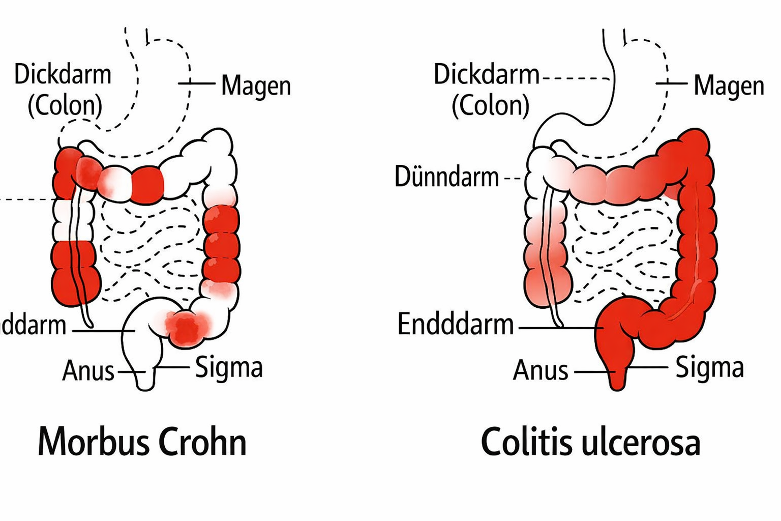 darmontsteking 1001010